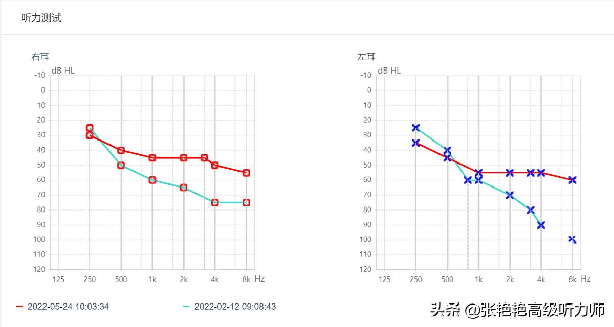 听力下降还能通过锻炼恢复吗,听力下降后还能恢复么