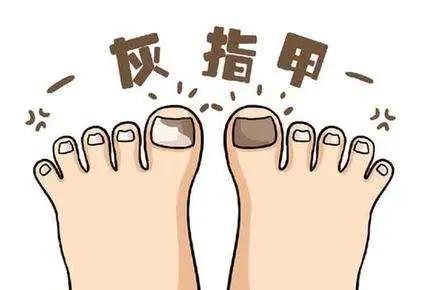 灰指甲在医院看哪个科,甲沟炎灰指甲在医院挂什么科