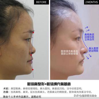 最让人显老的法令纹应该如何解决,法令纹和嘴角纹哪个更显老