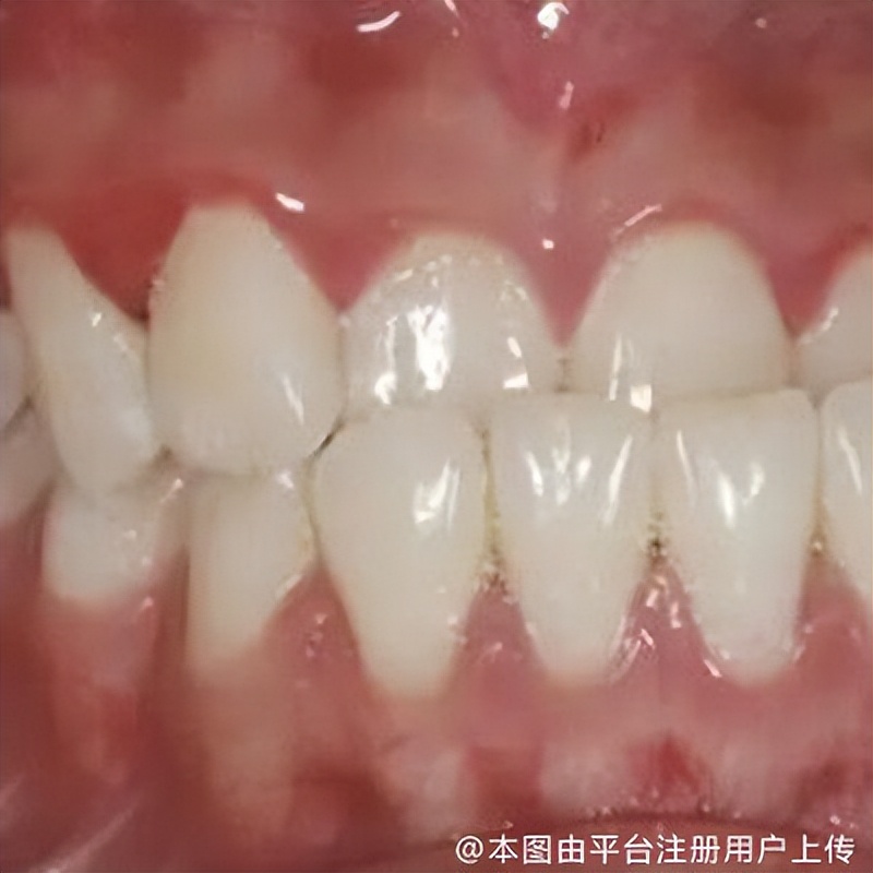 牙齿矫正求助,个别牙地包天怎么镶牙