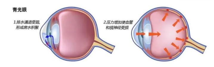 青光眼是怎么造成的,青光眼的症状和表现