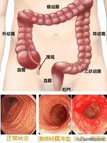 注意了,溃疡性结肠炎,一旦出现这3种迹象,十有八九在癌变