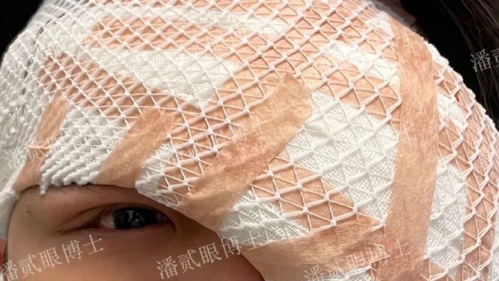 术后（重度上睑下垂）出现结膜脱垂怎么办？