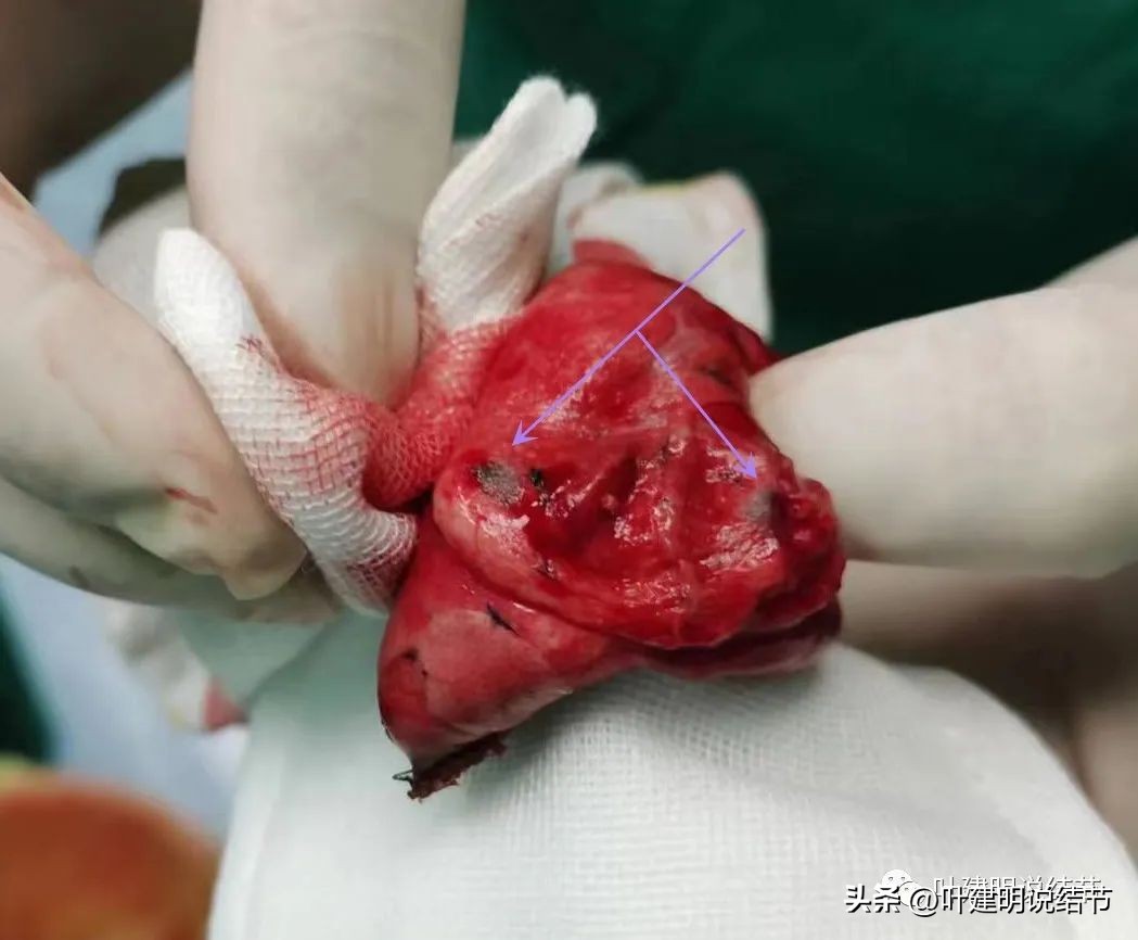 磨玻璃结节伴有增生是癌症吗,磨玻璃结节会是别的癌转移的吗