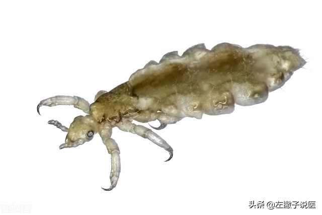 以前头上的虱子为什么现在也有呢,30年前人人身上都有的虱子