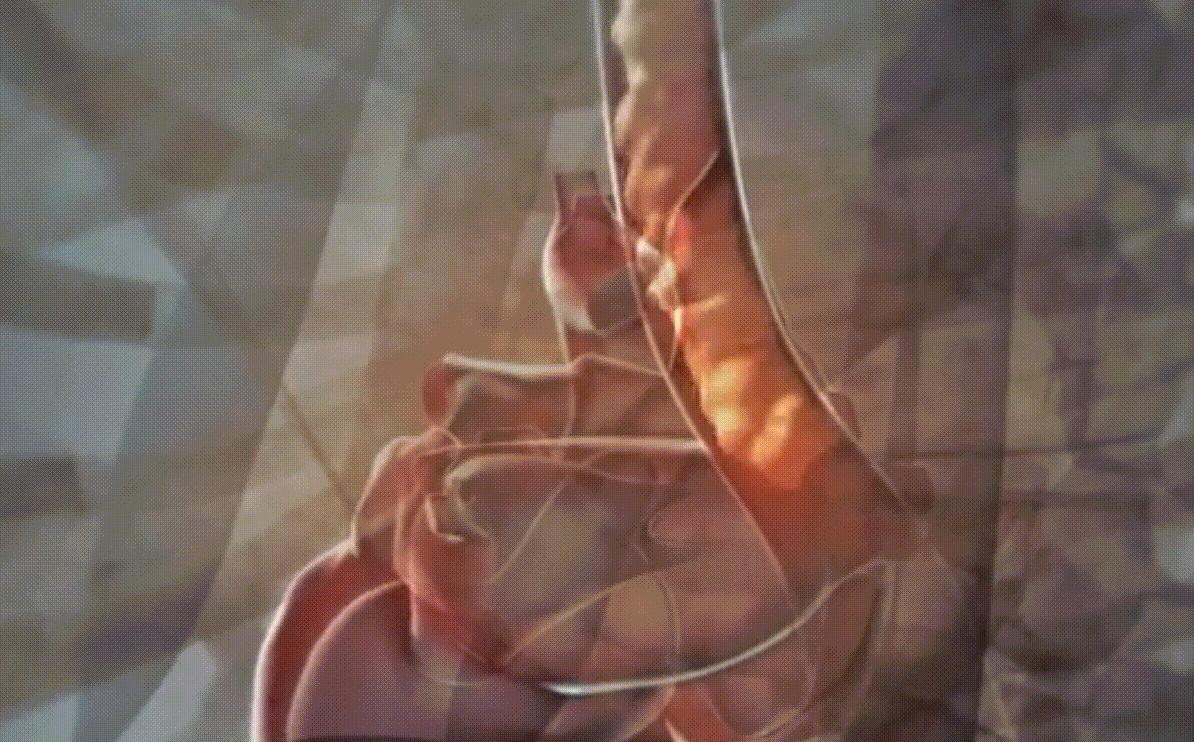 2010年,厦门小伙连续3月反复高烧,医生打开心脏夹出3厘米的鱼刺