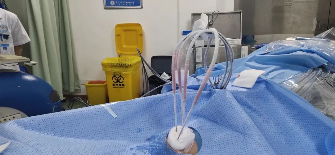 再次复查有所好转,氩氦刀冷冻消融术后患者不烧不痛