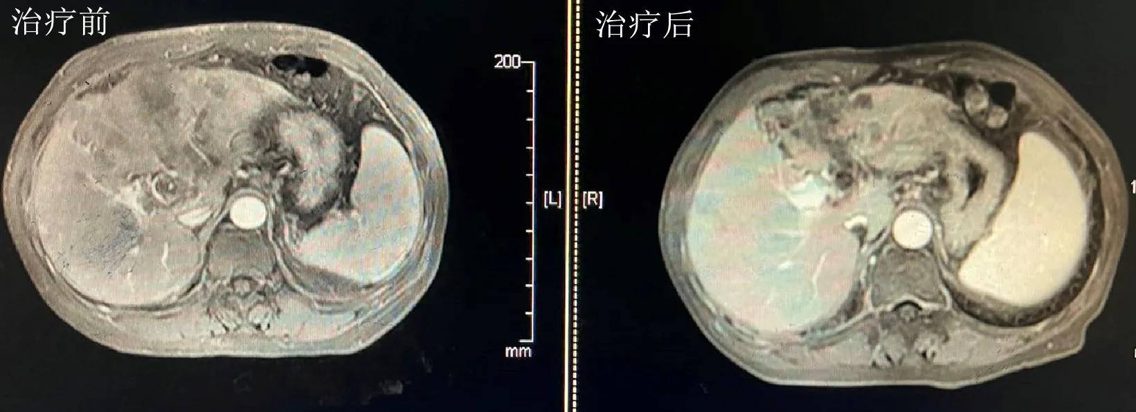 健康改善肝癌预后须把握这些要点,癌患者治疗整体缓解率什么意思