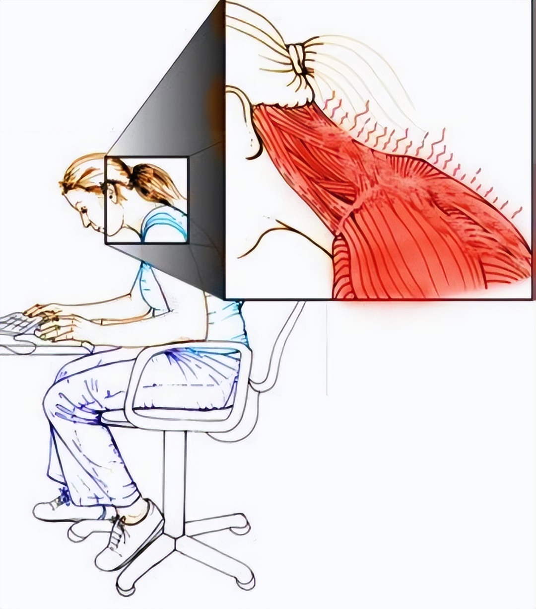 肩胛骨后背疼可能是肺癌吗,后背肩胛骨持续疼痛是肺癌吗