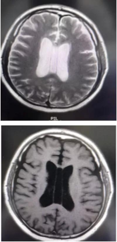 侧脑室就是透明隔腔吗,第五脑室是透明隔吗