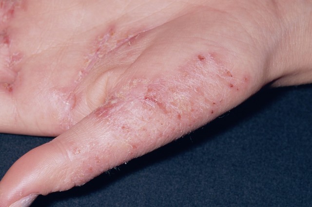 湿疹激素治疗副作用大吗,湿疹为什么不能大面积用激素