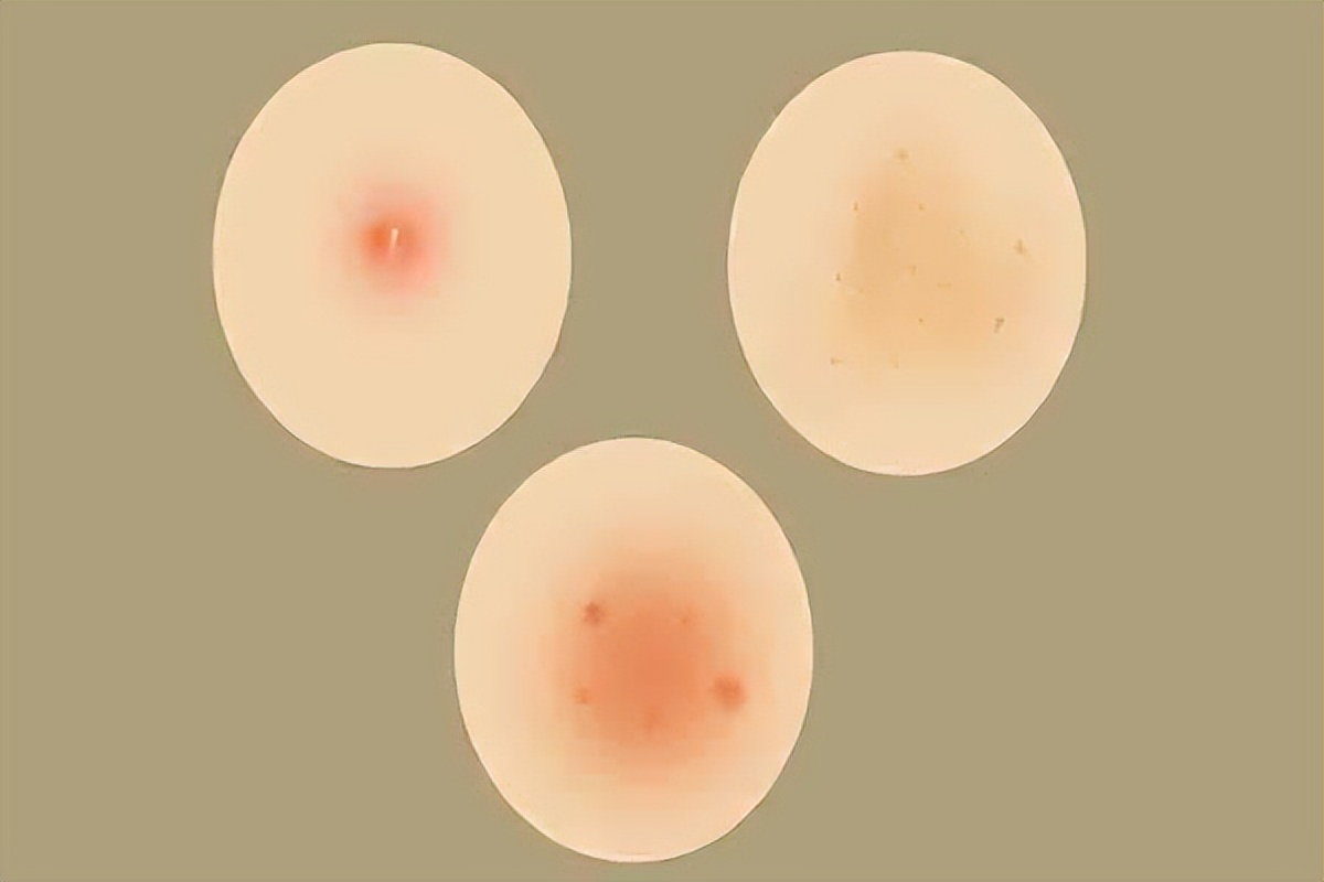 湿疹反复不会好怎么办婴儿,皮炎湿疹和真菌性湿疹有区别