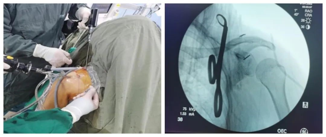 肩锁关节脱位秦皇岛市第一医院关节镜微创手术为患者解除痛苦