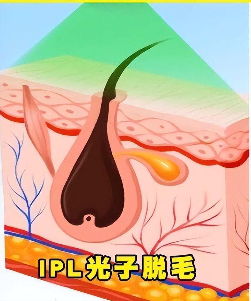 光子和脱毛谁更痛,光子与脱毛仪一样吗