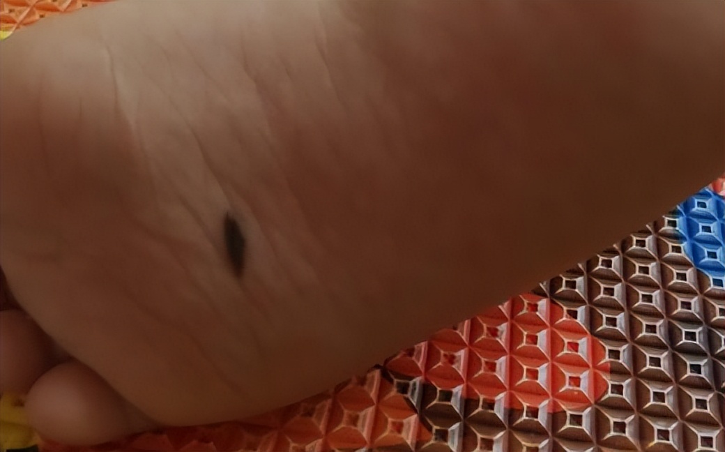 黑痣长在脸上各部位代表什么图片,医生说黑痣有癌变的可能怎么办