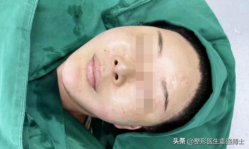 杭州女孩全脸填充100针玻尿酸,女子花45万注射玻尿酸