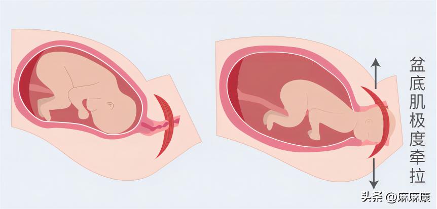 盆底肌紧张慢性盆腔痛,憋不住小便的时候盆底肌疼