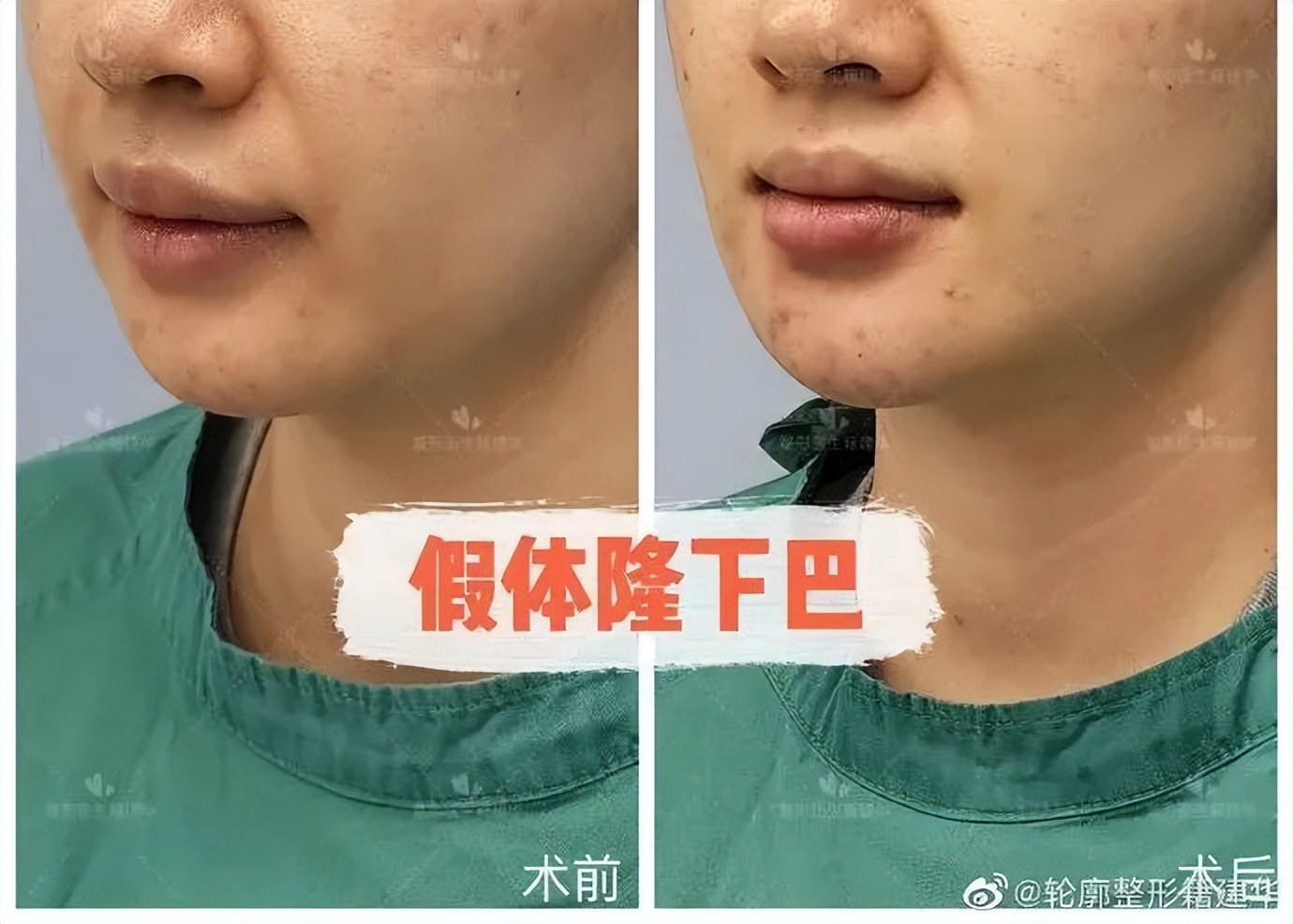 下巴后缩是不是最难看的,下巴后缩明星怎么改善