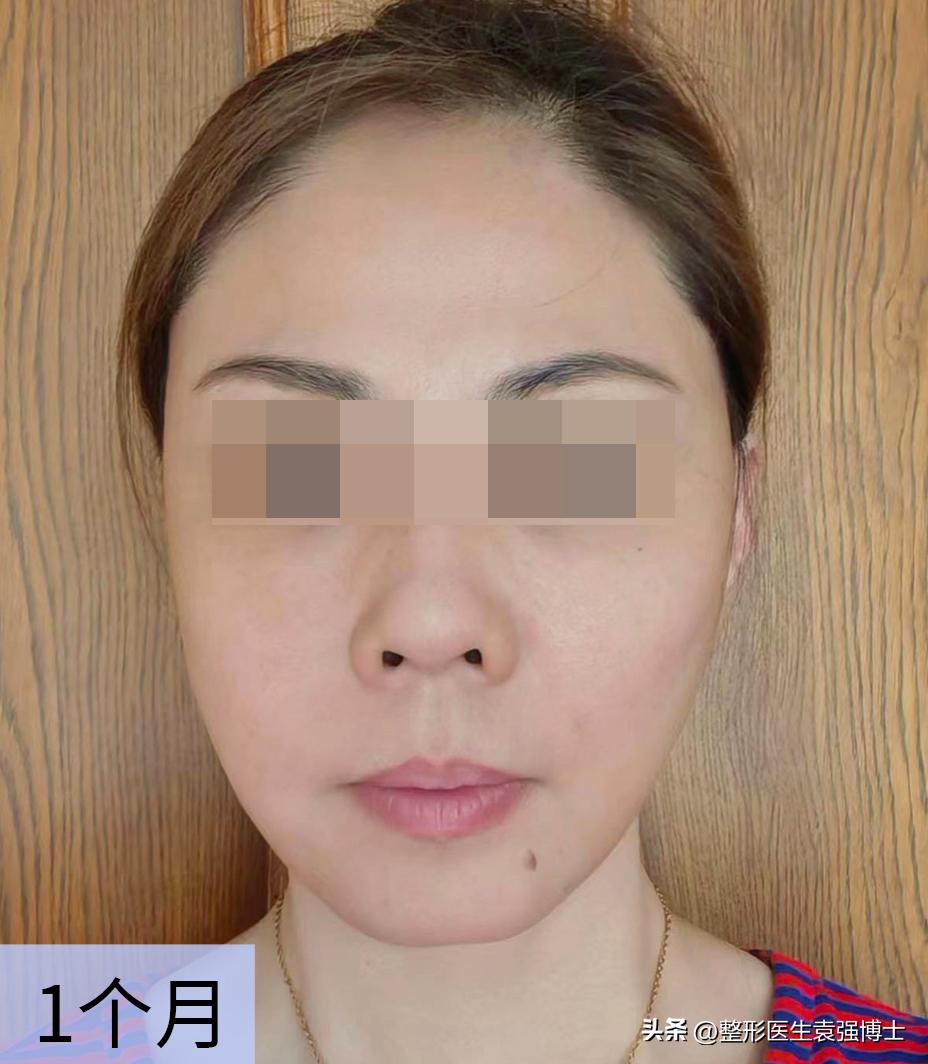 大拉皮多久可以修复大小脸,面部整体轻微松弛可以做大拉皮吗