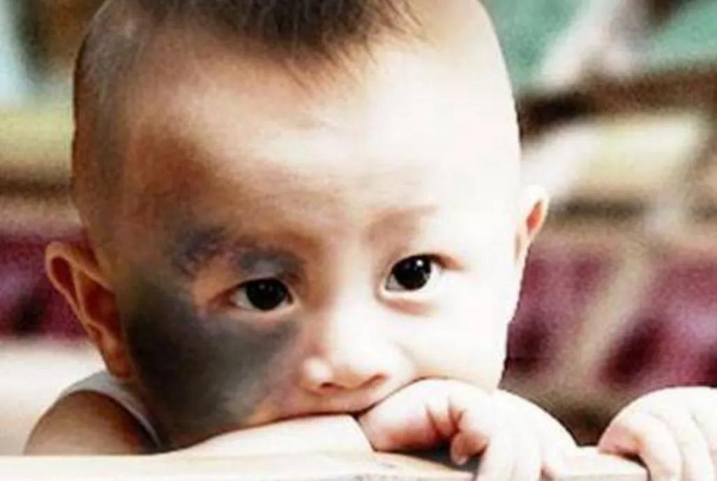 宝宝身上的胎记怎么形成的,怎么避免胎儿长胎记