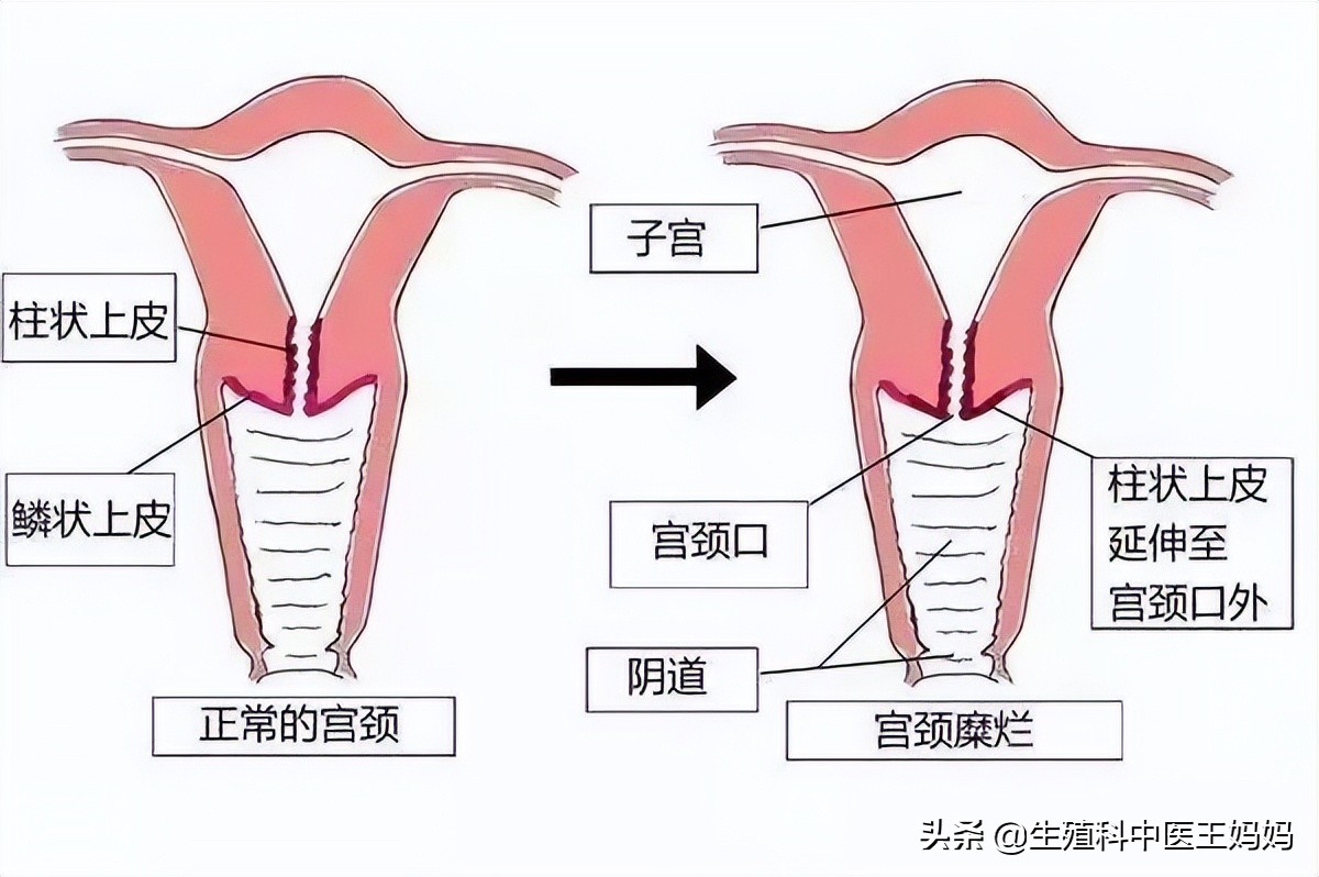 女子宫颈糜烂要不要紧,女子被医院切掉子宫