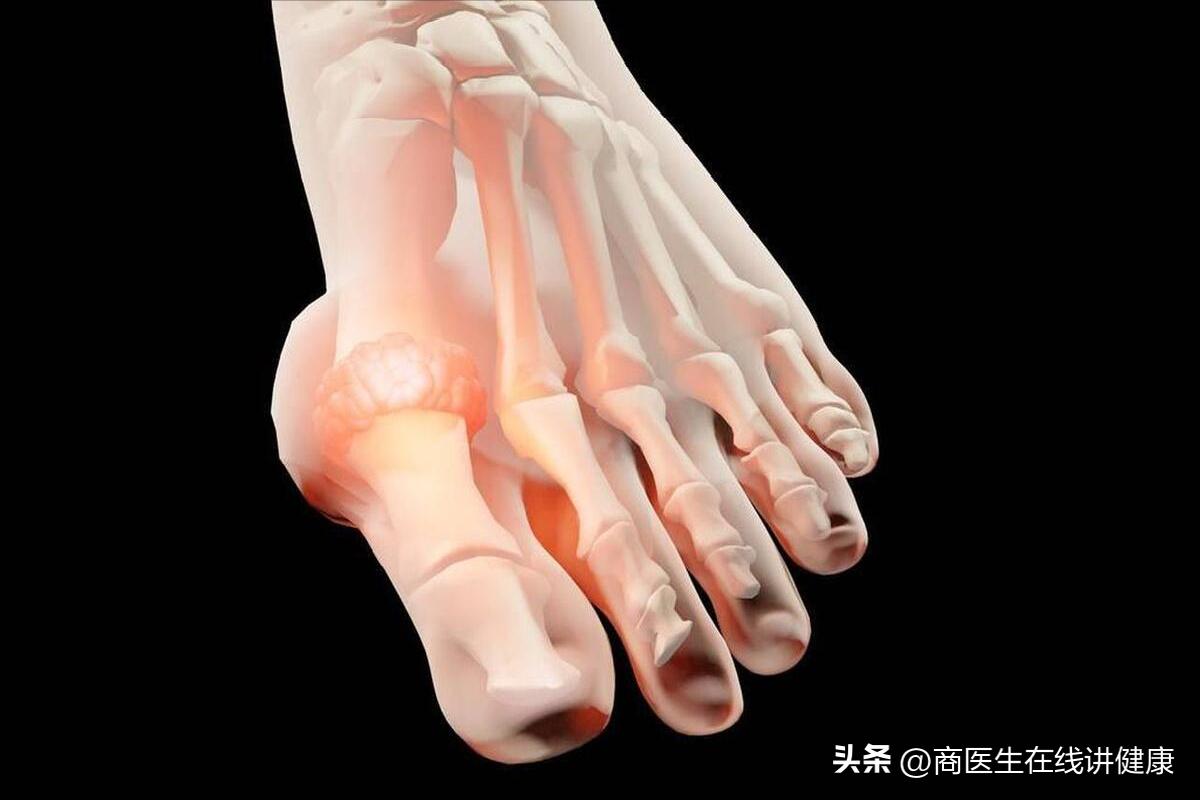 怎样防止糖尿病足,糖尿病足出现三种情况要注意了