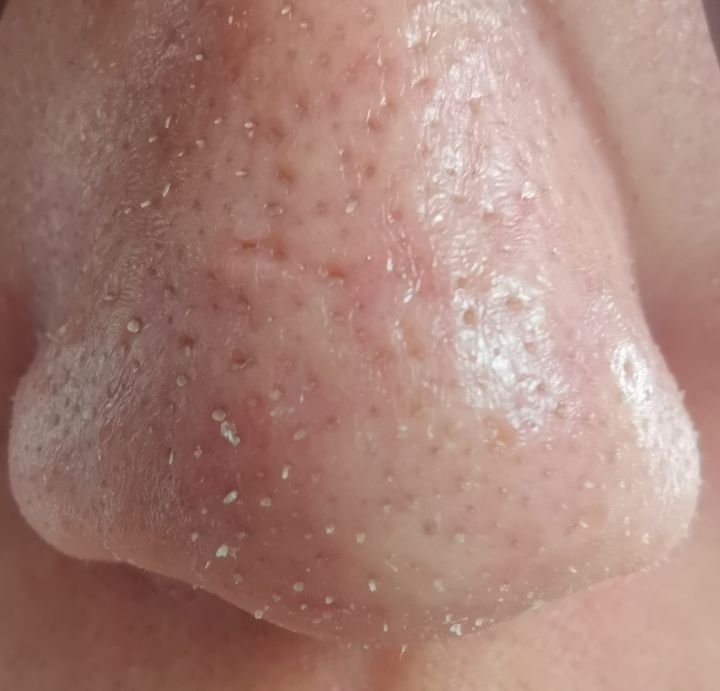 超微小气泡美容有用吗,美容院小气泡