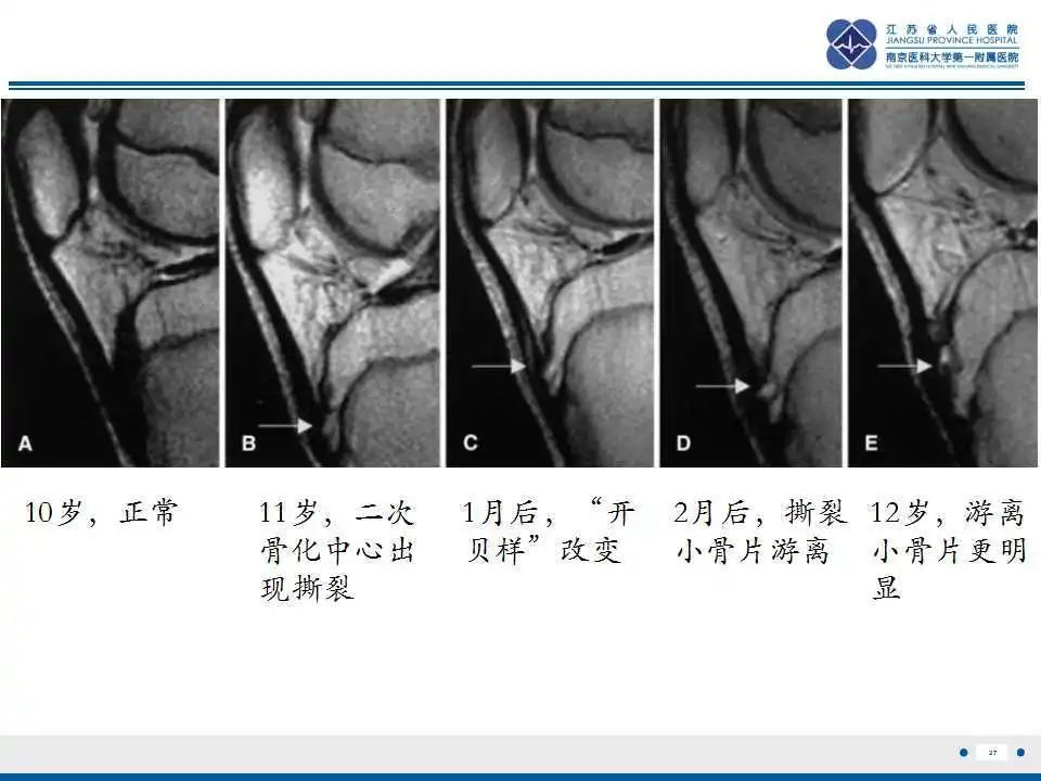 胫骨结节软骨炎要怎么治疗,胫骨结节骨软骨炎会癌变吗