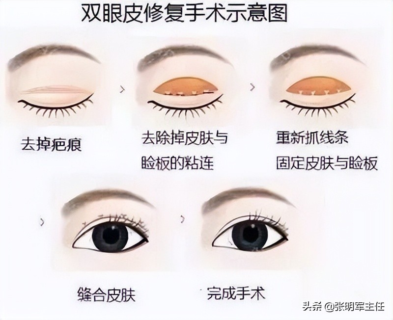 眼皮耷拉、松弛、三角眼，医生建议用两种方法改善