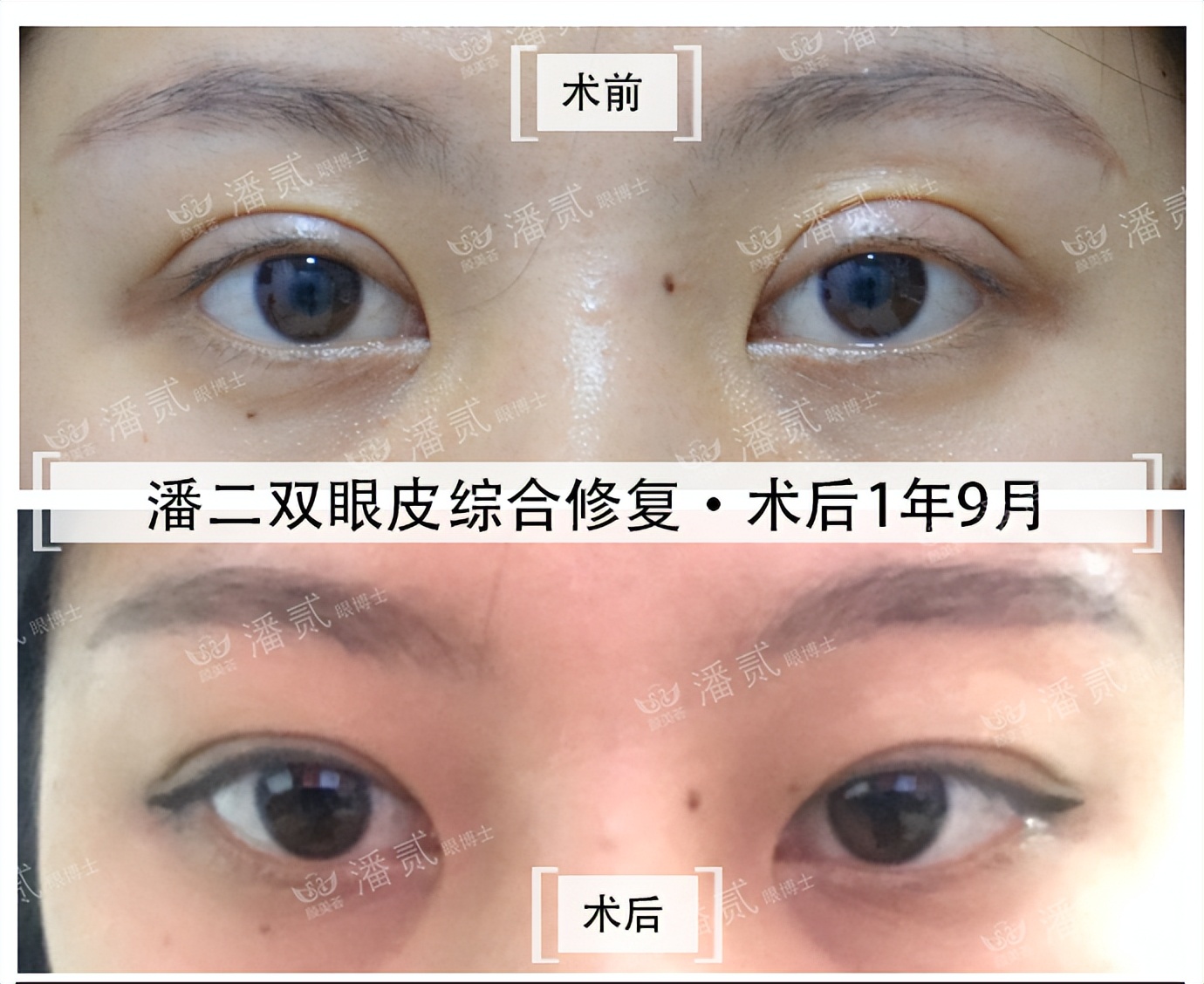 双眼皮贴导致眼皮破了,双眼皮贴导致眼皮严重下垂恢复