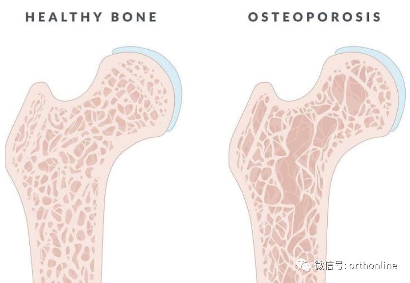 无细胞脂肪活性蛋白预防骨质疏松研究