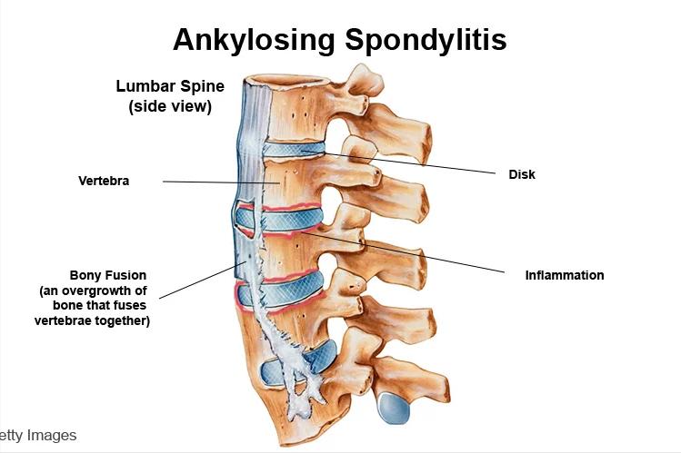 治疗强直性脊柱炎必须按体质治吗,针对强直性脊柱炎最好的锻炼方法