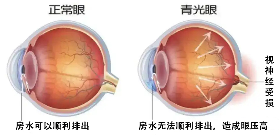 什么是青光眼,什么是青光眼通俗易懂