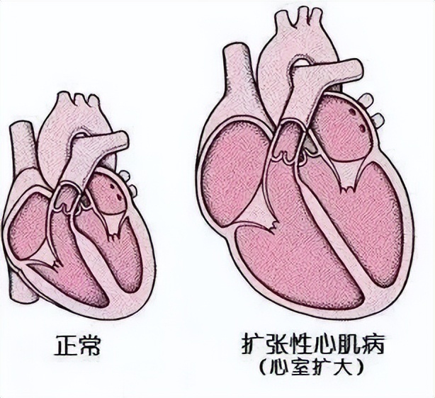 扩张型心肌病之科普小问答四,扩张型心肌病之科普四