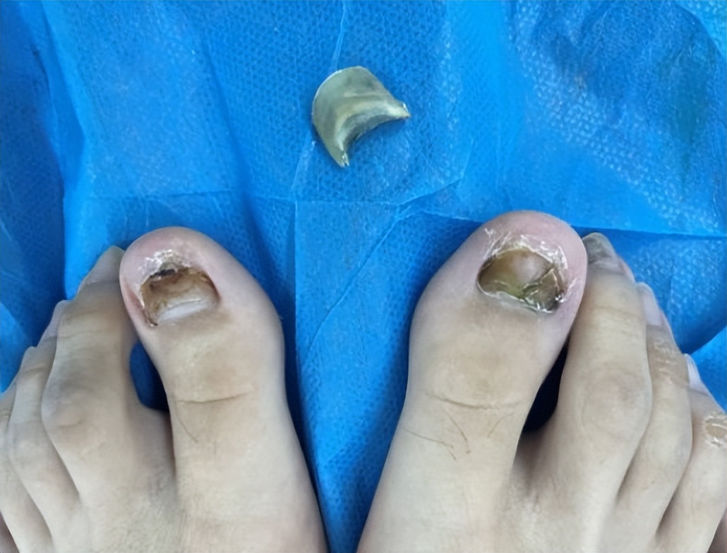 甲沟炎取出嵌甲后怎么矫正,嵌甲矫正器治疗嵌甲注意事项