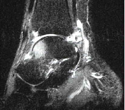 脚背及脚踝疼痛见于哪些疾病,脚踝外侧面疼痛警惕大病