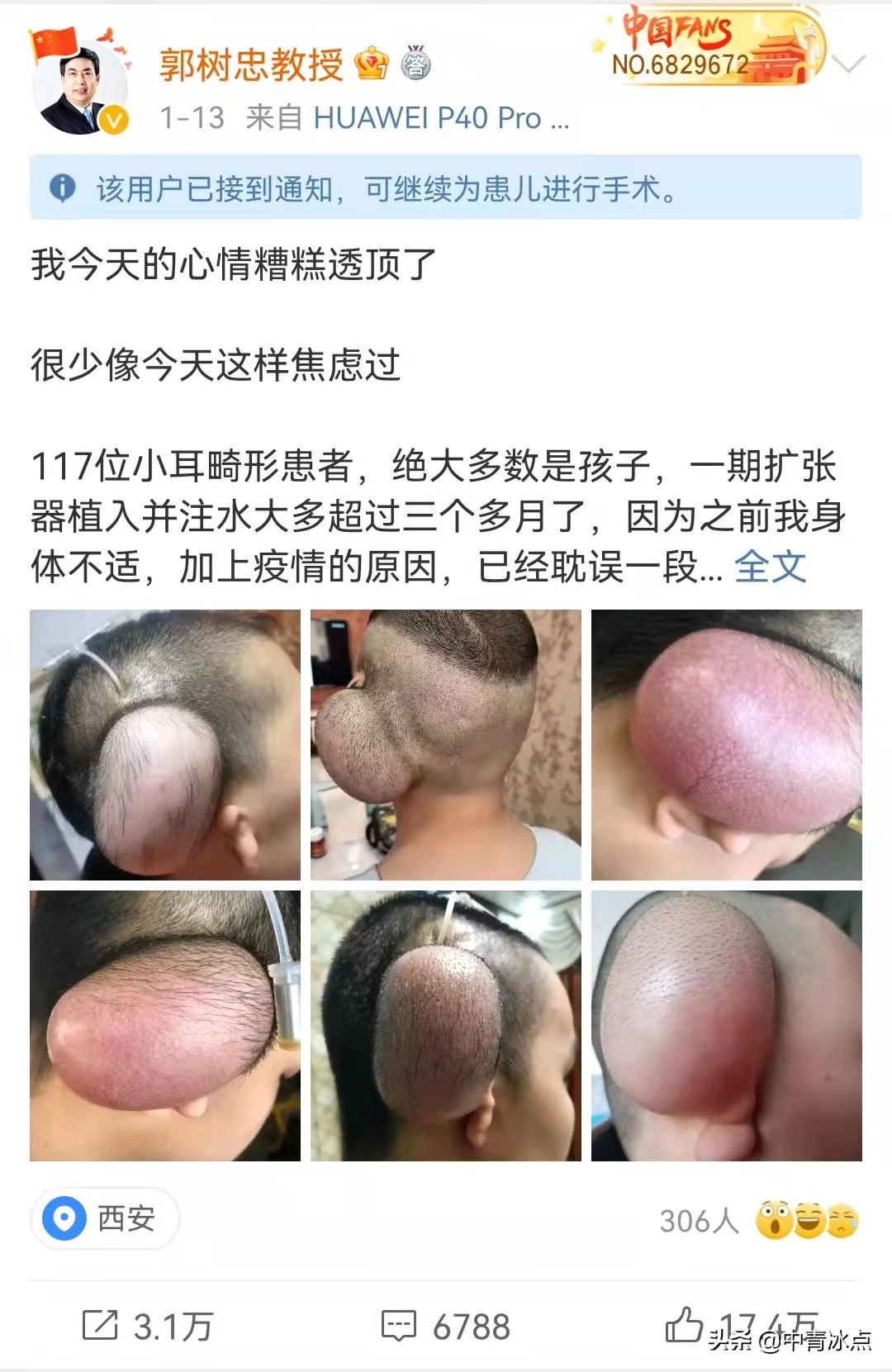 还记得西安疫情中117个脑袋挂着“水球”的小耳症患者吗？主刀医生发微博着急做手术，后来呢？