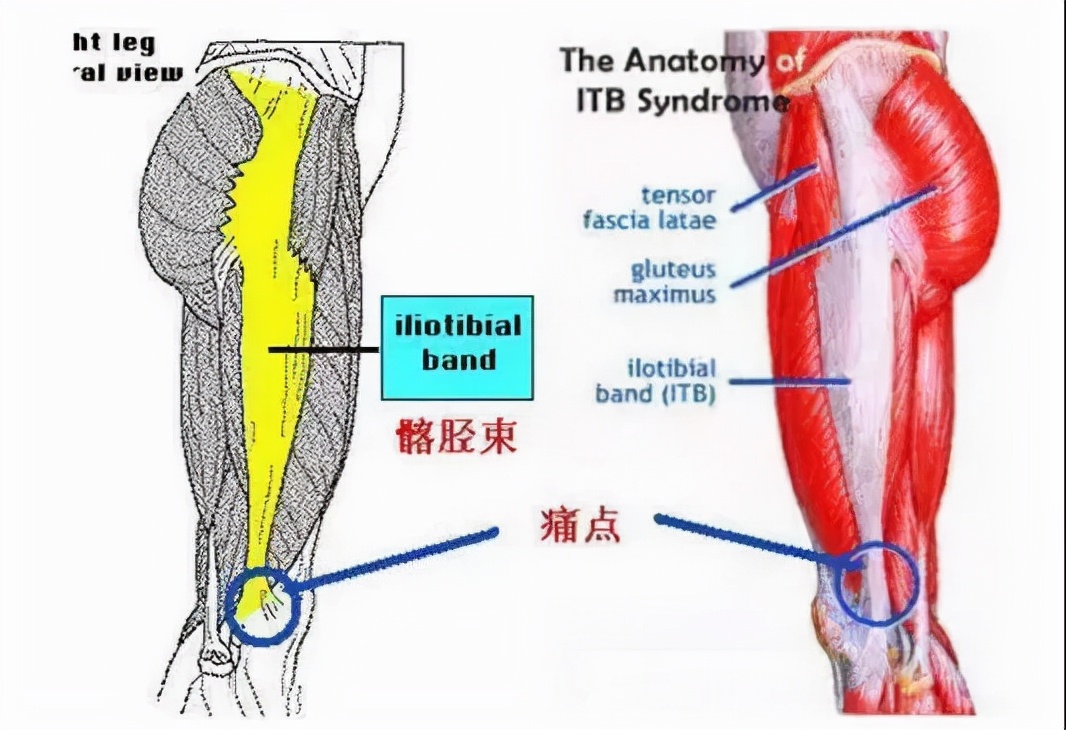 膝盖外侧疼痛，有救了！这几种方法拯救你的髂胫束