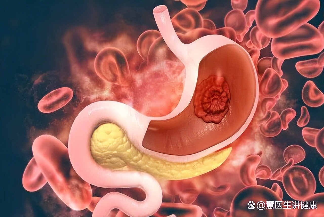 从胃炎到胃癌用多长时间,从胃炎到胃癌一般经过哪几个阶段