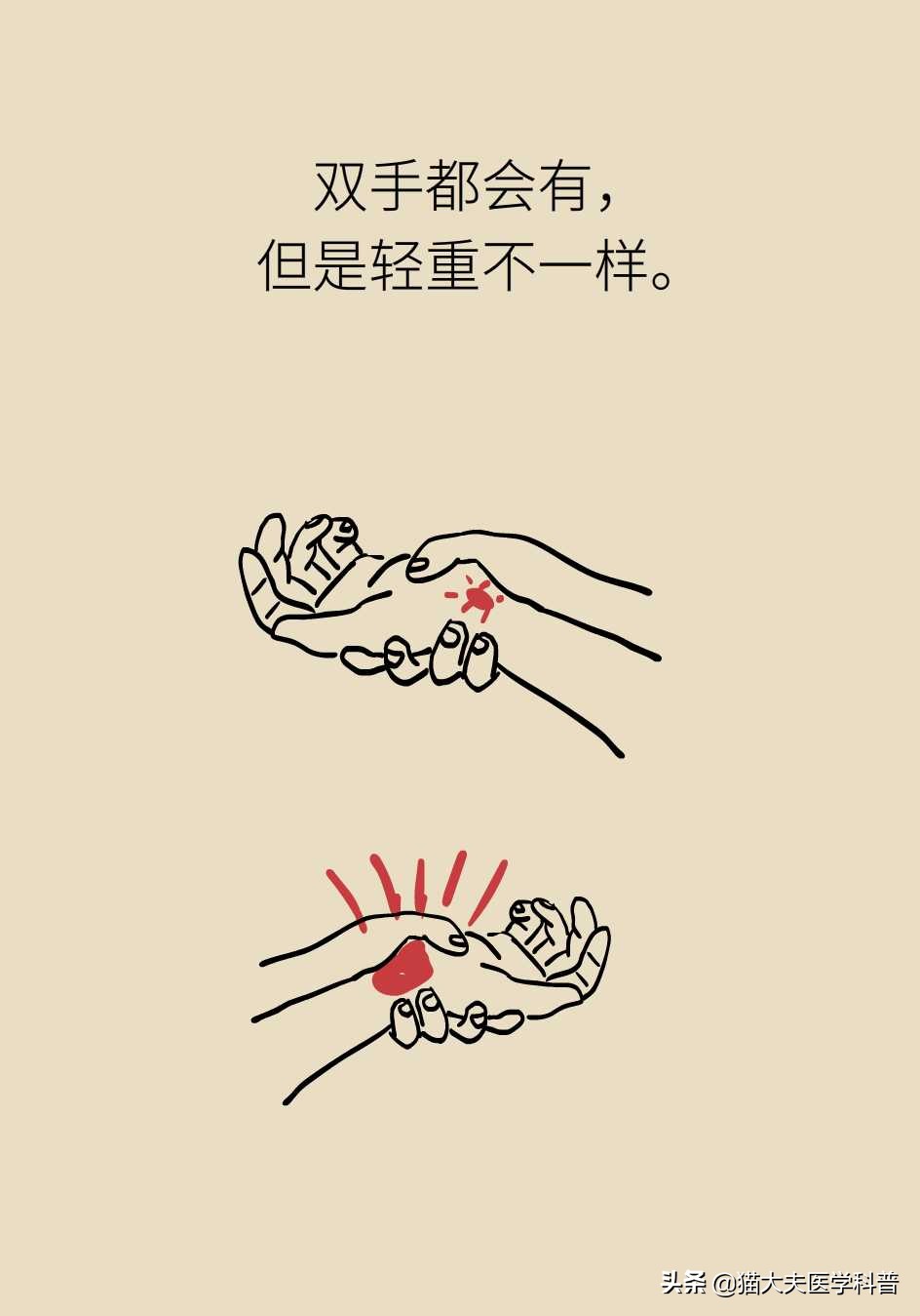 手麻没劲一定是脊髓型颈椎病吗,手麻脖子不舒服是颈椎病吗