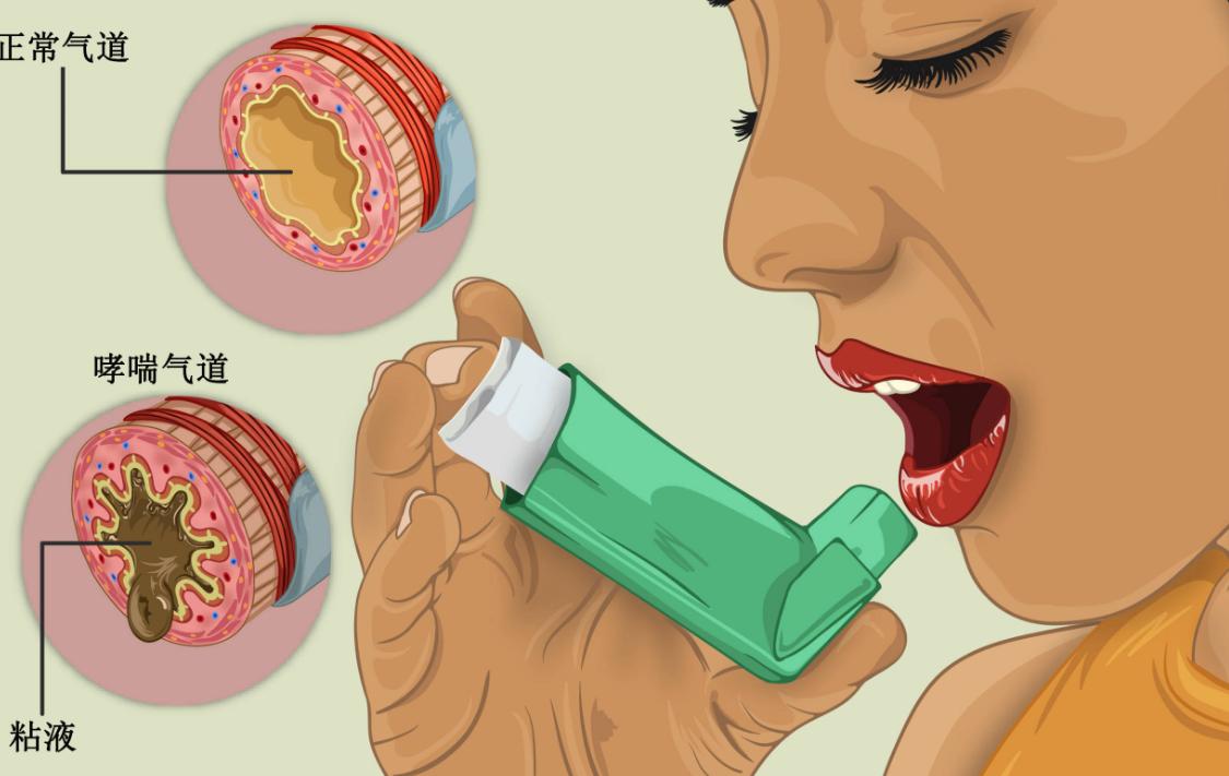 尘螨过敏脱敏治疗医保报销吗,尘螨1级过敏需要脱敏治疗吗