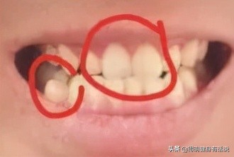 牙齿快暴露牙本质了怎么修复,牙齿已经露出牙本质了怎么修复