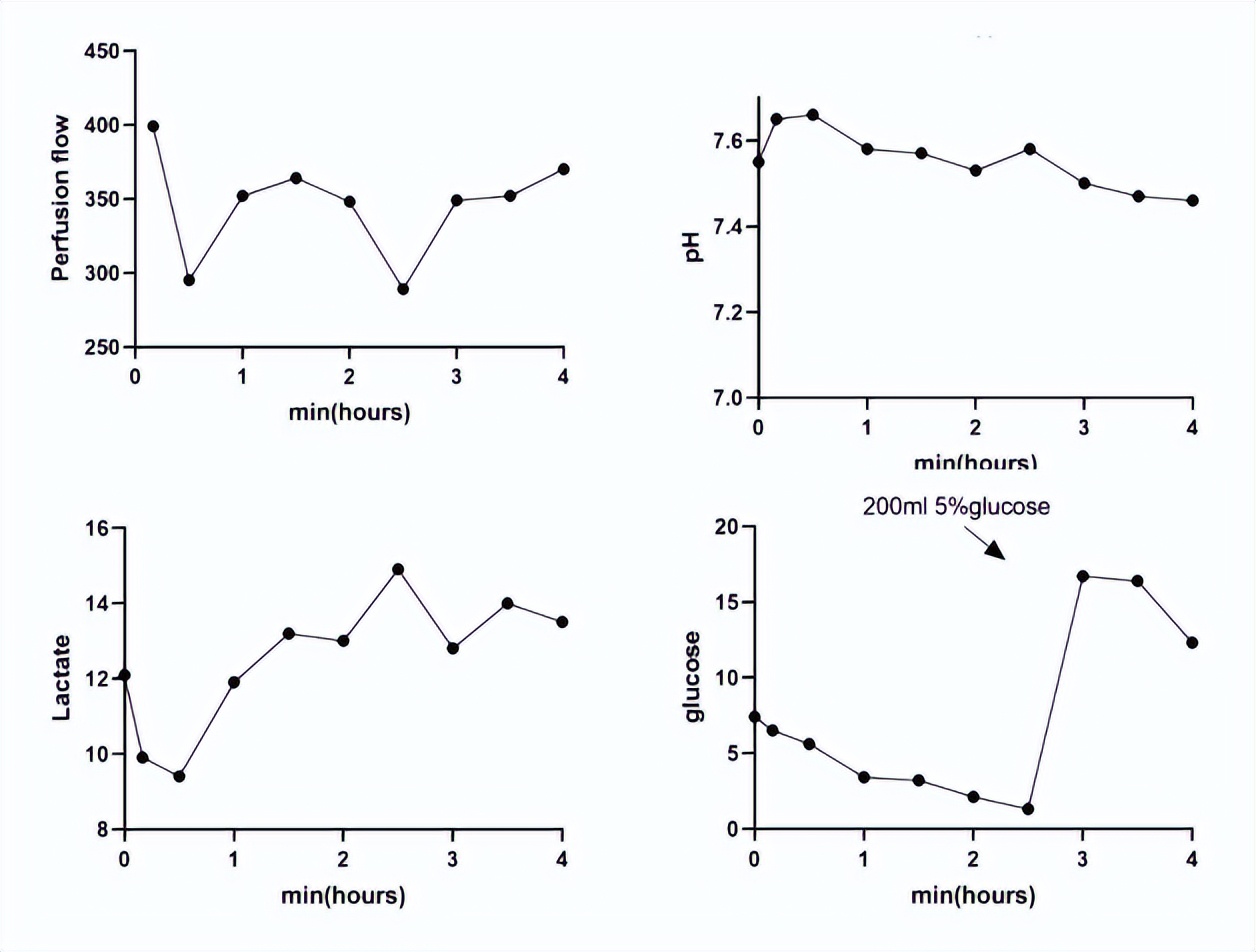 骨肿瘤骨盆重建手术,骨肿瘤多处转移还能治愈吗