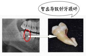 健康科普龋齿涂氟,一分钟看懂智齿的秘密