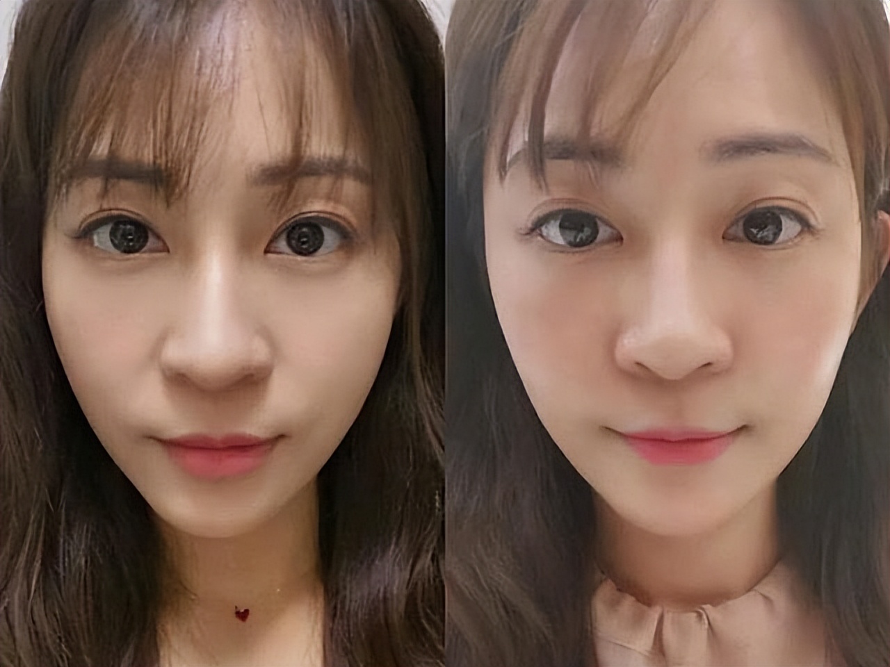 比法令纹更靠上的纹,嘴凸有法令纹改善对比