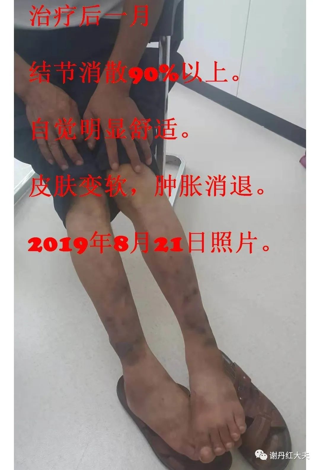 胫前黏液性水肿见于哪些病,胫前黏液性水肿为凹陷性水肿吗