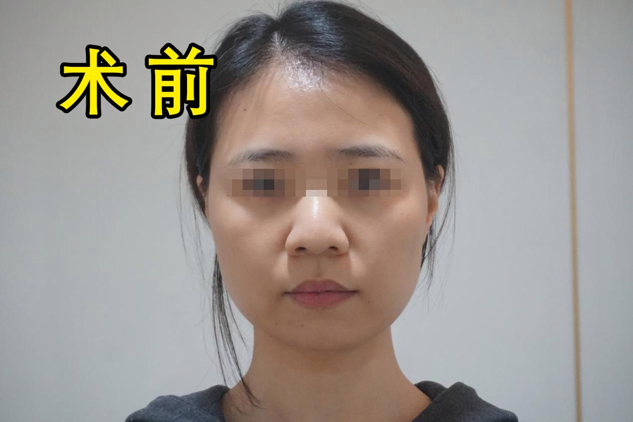 30岁女人做脸部美容,脸部面吸手术后的真实感受
