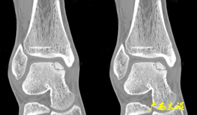 距骨软骨损伤最好的治疗方法,距骨软骨损伤的诊断