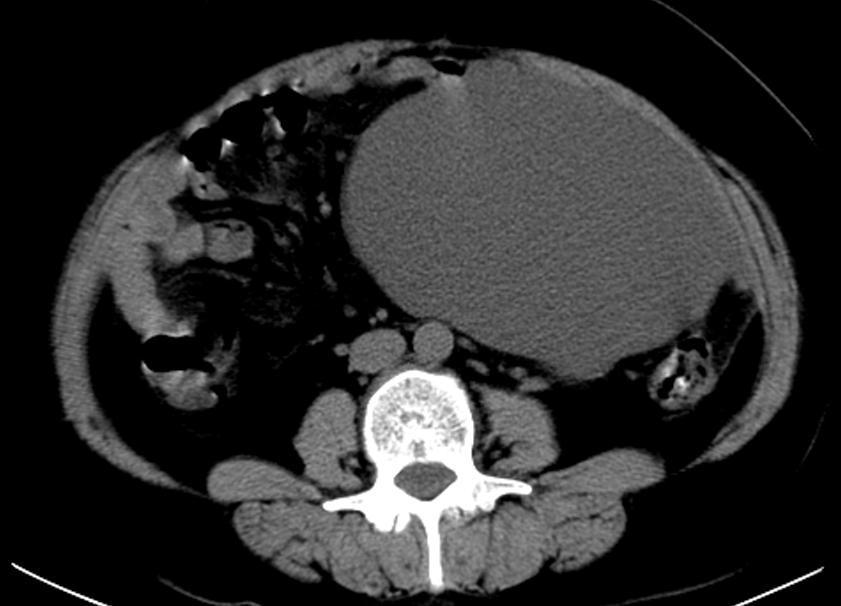 卵巢癌患者BRCA1突变,卵巢癌检测有胚系brca1突变
