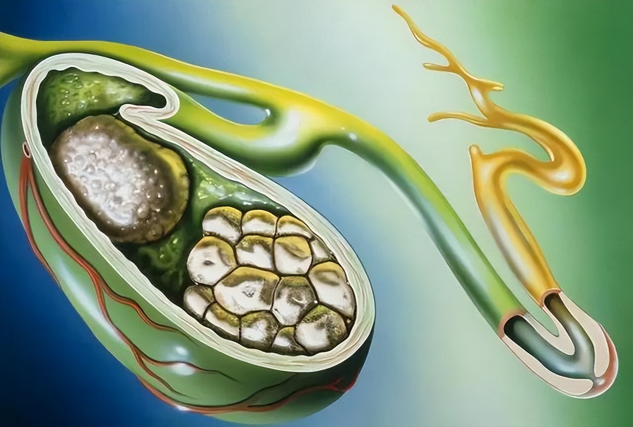 结石的治疗方法和饮食,结石可以通过吃什么缓解